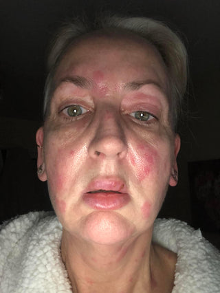 WillPowders Customer Sam Before